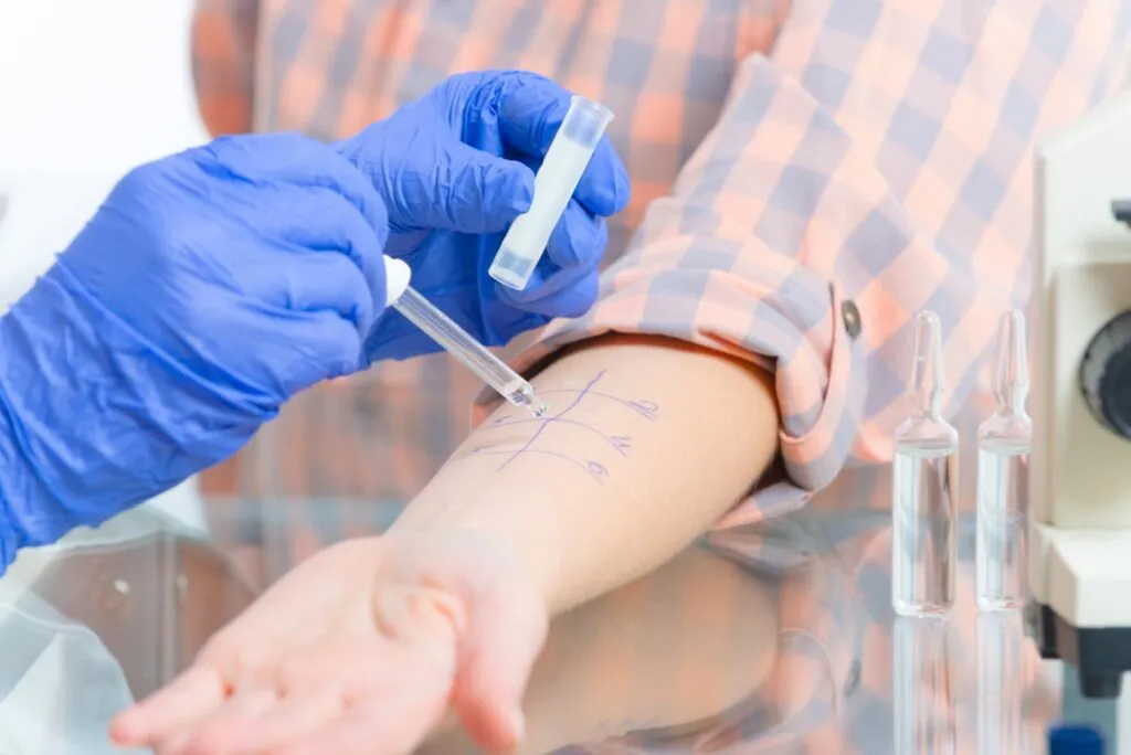 Un allergologue proc&egrave;de &agrave; un prick test