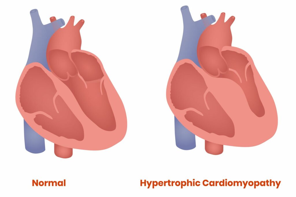 illustration d'un coeur sain et d'un coeur souffrant de cmh